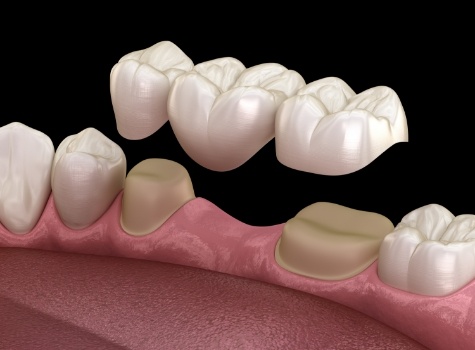 Animated dental bridge replacing a missing tooth