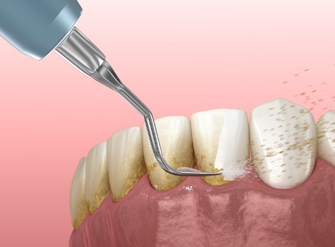 Animated dental tool removing plaque from teeth