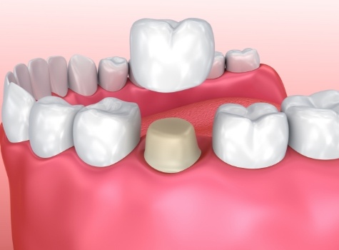 Animated dental crown being fitted over a tooth