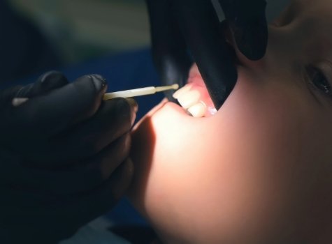 Dental team member applying fluoride to a child's teeth