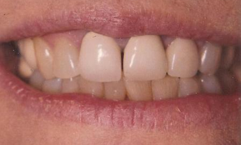 Close up of smile with stained uneven teeth