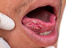 Oral cancer lesion