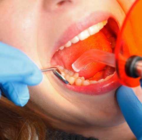 Close up of dental patient getting cosmetic dental bonding in Hoover