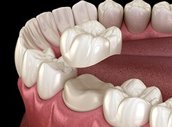 A single dental crown