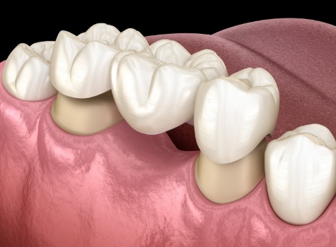 Animated dental bridge being placed in the mouth