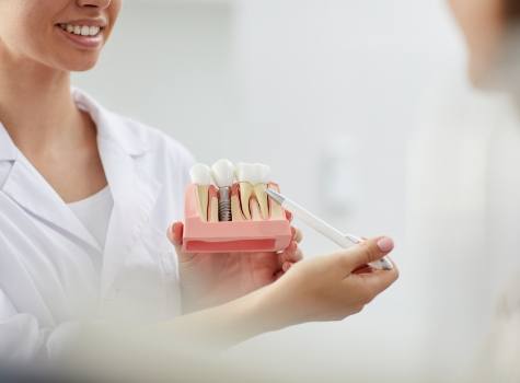 Dentist showing a patient a model of dental implants in Hoover
