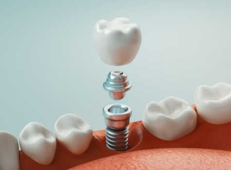 Animated dental implant being placed in the mouth