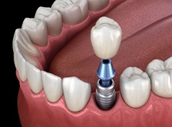 Animated dental implant with dental crown