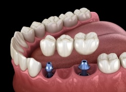 Animated dental implant bridge