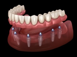 Animated implant denture