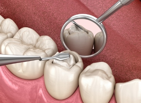 Animated dental instruments placing dental sealants on teeth