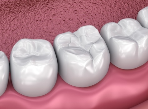Animated tooth with dental sealants