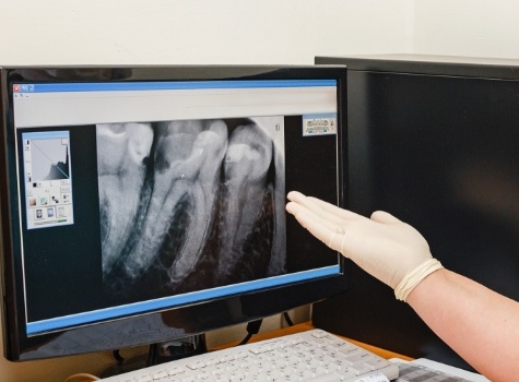 Dentist gesturing to digital dental x rays on computer screen