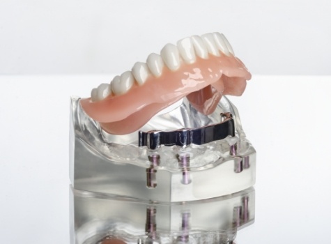 Model of an implant denture