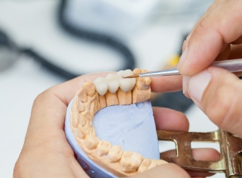 Dentist crafting a partial denture