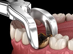 A 3D illustration of a tooth extraction