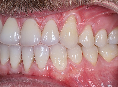 Image of gum recession