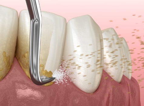 Animated dental scaler removing plaque from teeth