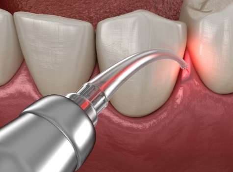 Animated soft tissue laser treating gum disease