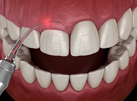 Illustration of laser gum recontouring