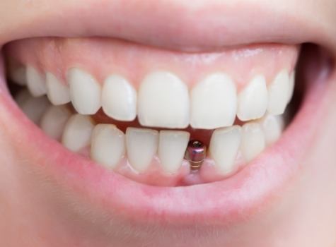 Close up of smile with a dental implant