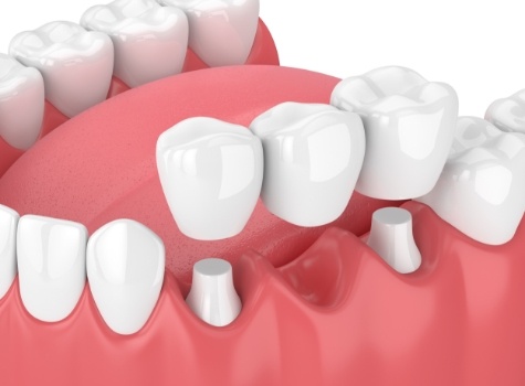 Animated dental bridge replacing a missing tooth