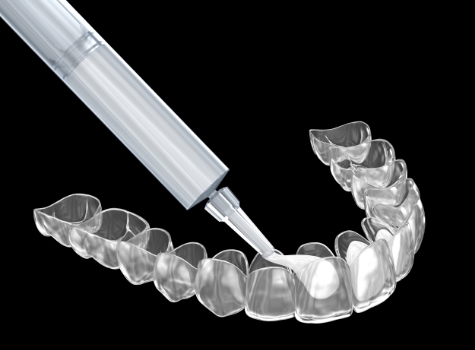 Teeth whitening tray being filled with bleaching gel