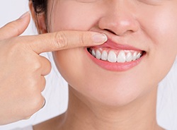 Woman pointing to her gums