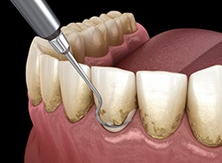 Digital illustration of scaling and root planing