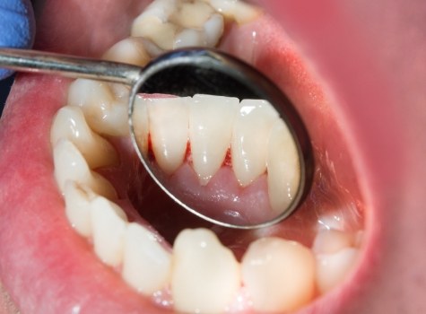 Close up of dental mirror inside of a mouth