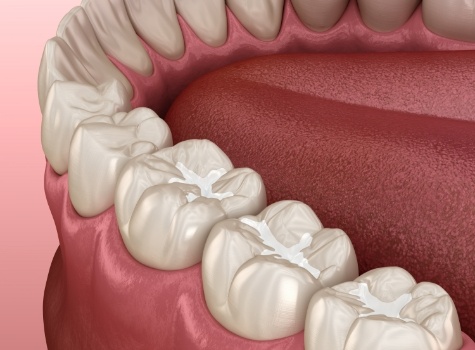 Animated row of teeth with tooth colored fillings