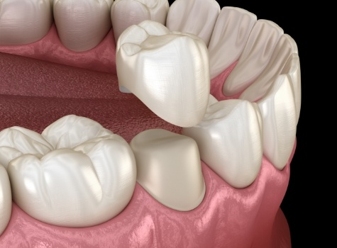 Animated dental crown being placed over a tooth