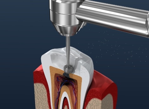 Animated tooth receiving root canal treatment