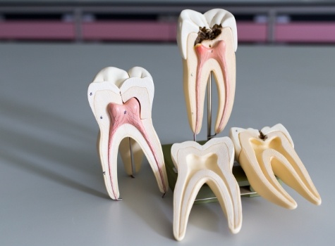 Models of damaged teeth needing root canal treatment