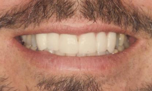 Close up of smile with white teeth