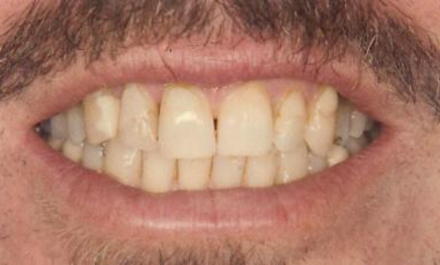 Close up of smile with discolored teeth