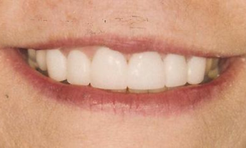 Close up of smile with bright evenly spaced teeth