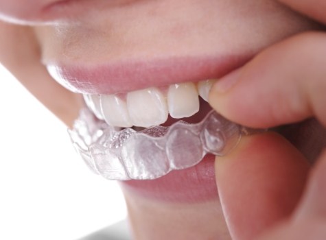 Close up of person putting SureSmile clear aligner in their mouth