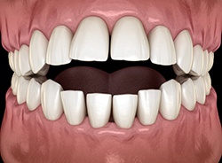Illustration of an open bite