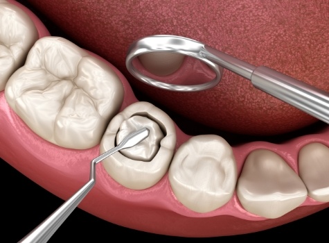 Animated tooth colored filling being placed in a tooth