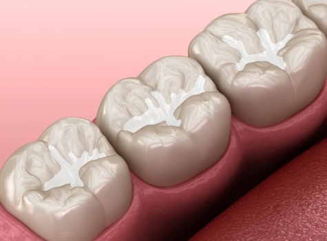 Animated row of teeth with tooth colored fillings