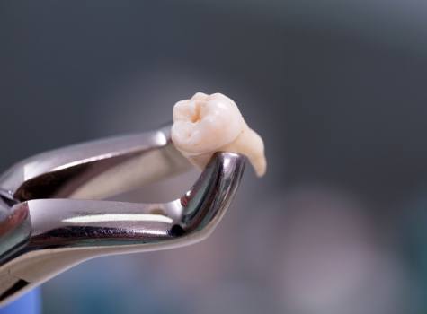 Dental forceps holding an extracted tooth