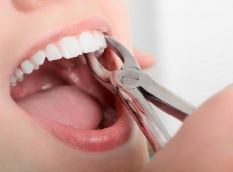 Dentist performing a tooth extraction in Hoover