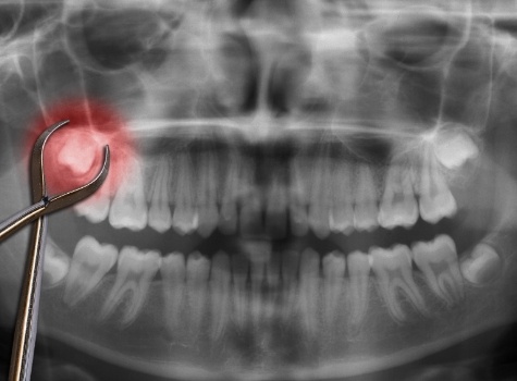 Dental forceps on top of x ray showing impacted wisdom tooth highlighted red