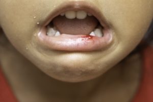 child crying with a bloody lip
