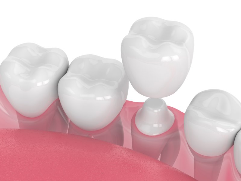 illustration of a dental crown in Birmingham