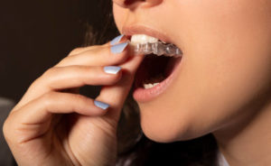 Woman inserting upper clear aligner