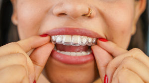 a close-up of a patient holding a clear aligner