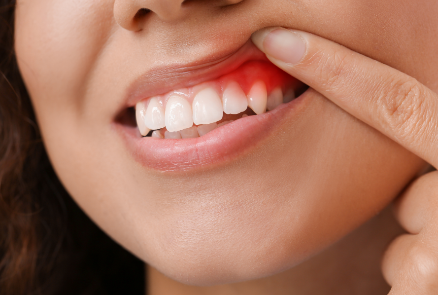 Woman's smile with inflammed, red gums
