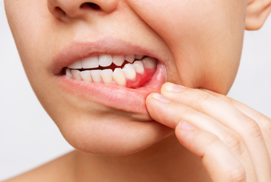Close up of woman's mouth showing reddened gums